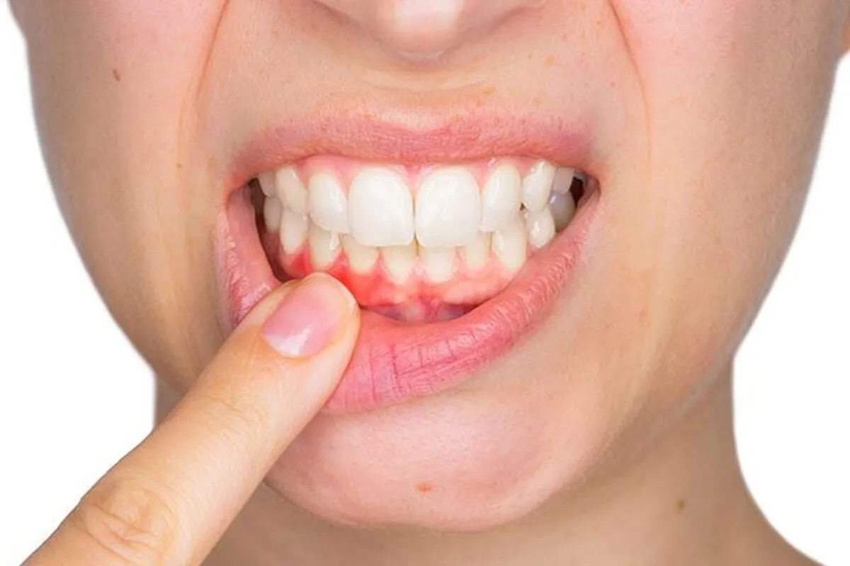 Understanding What Causes Gingivitis and How to Prevent It