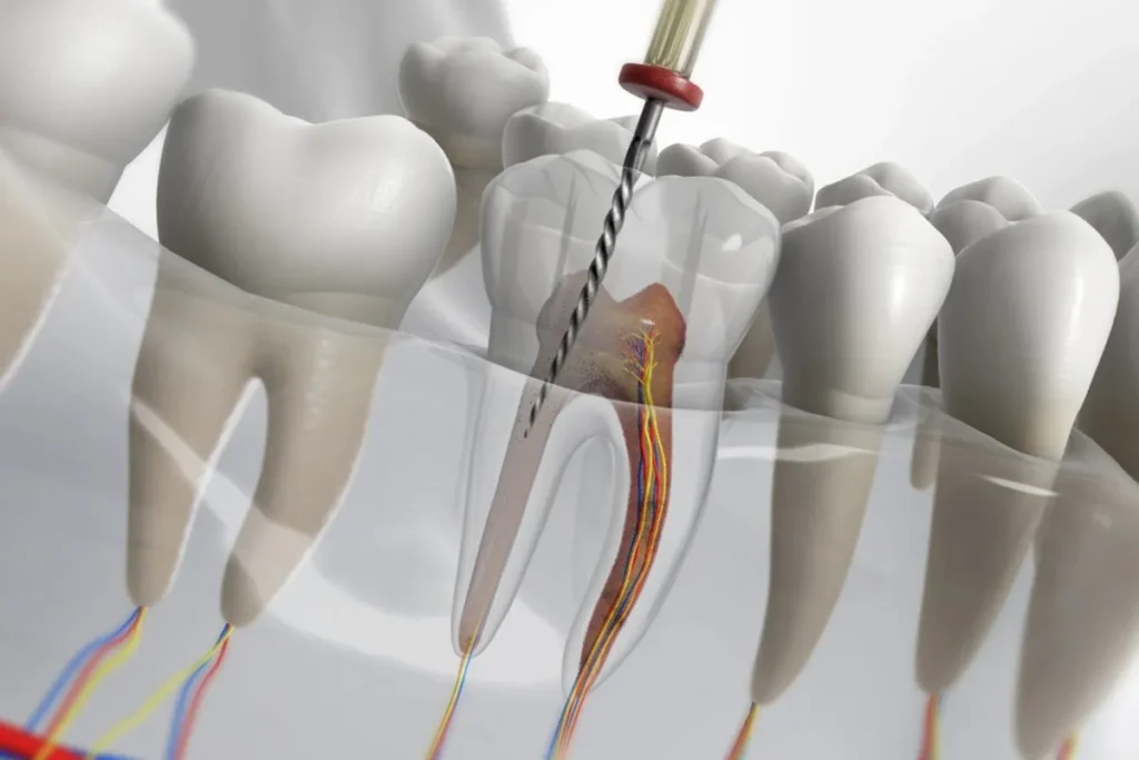 Understanding Endodontics Meaning – Gold City Dental