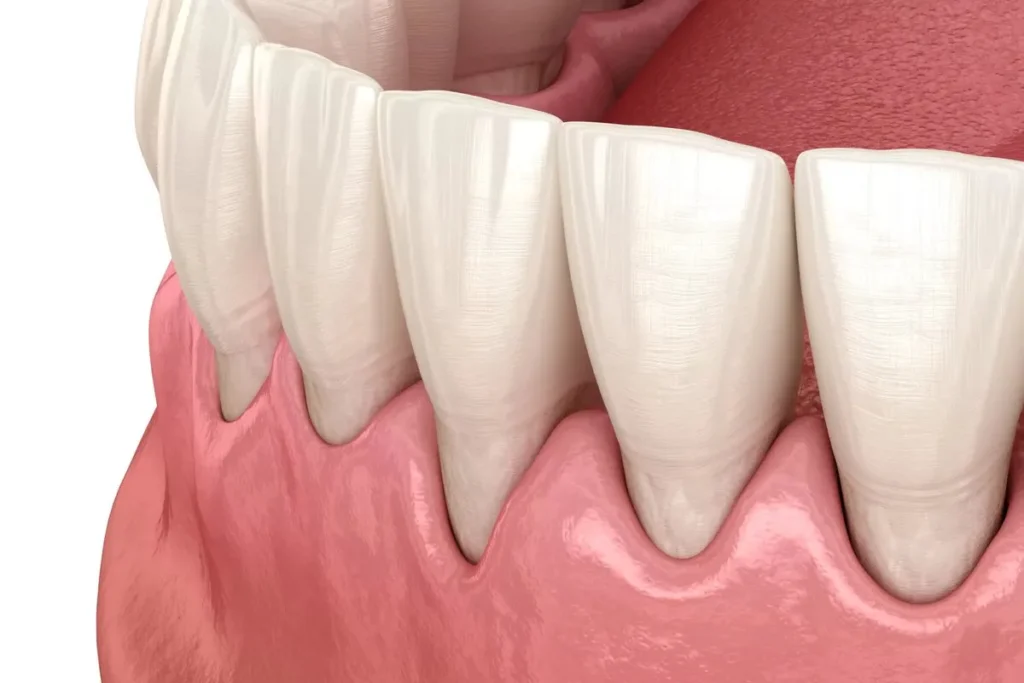 Normal vs Receding Gums: Visual Differences