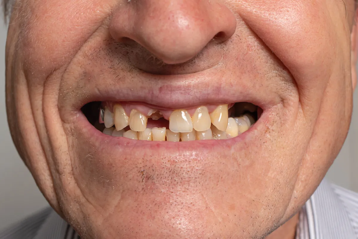 What Age Do Teeth Fall Out Adults? Facts