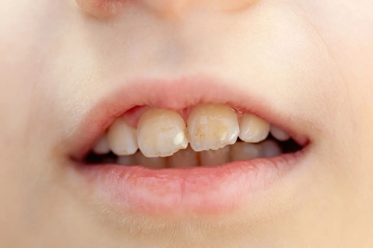 UV Teeth Whitening: Fast, Safe, Professional Brightening