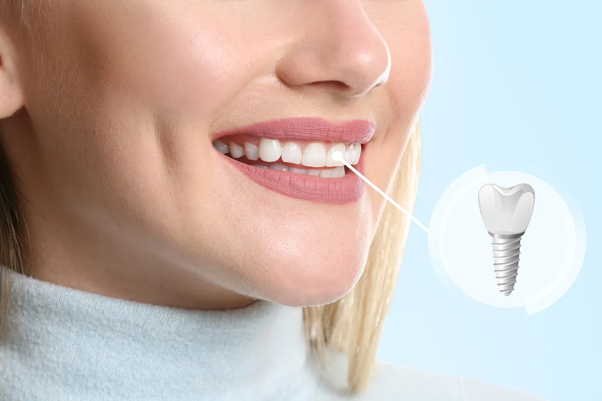 Full Mouth Dentures Implants – Confident Smile