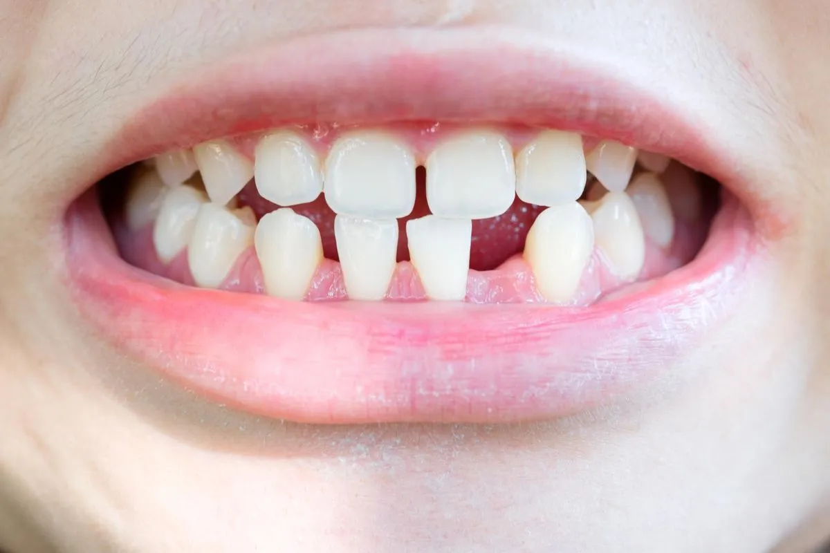 Implant Abutment Guide: Secure, Comfortable Restorations