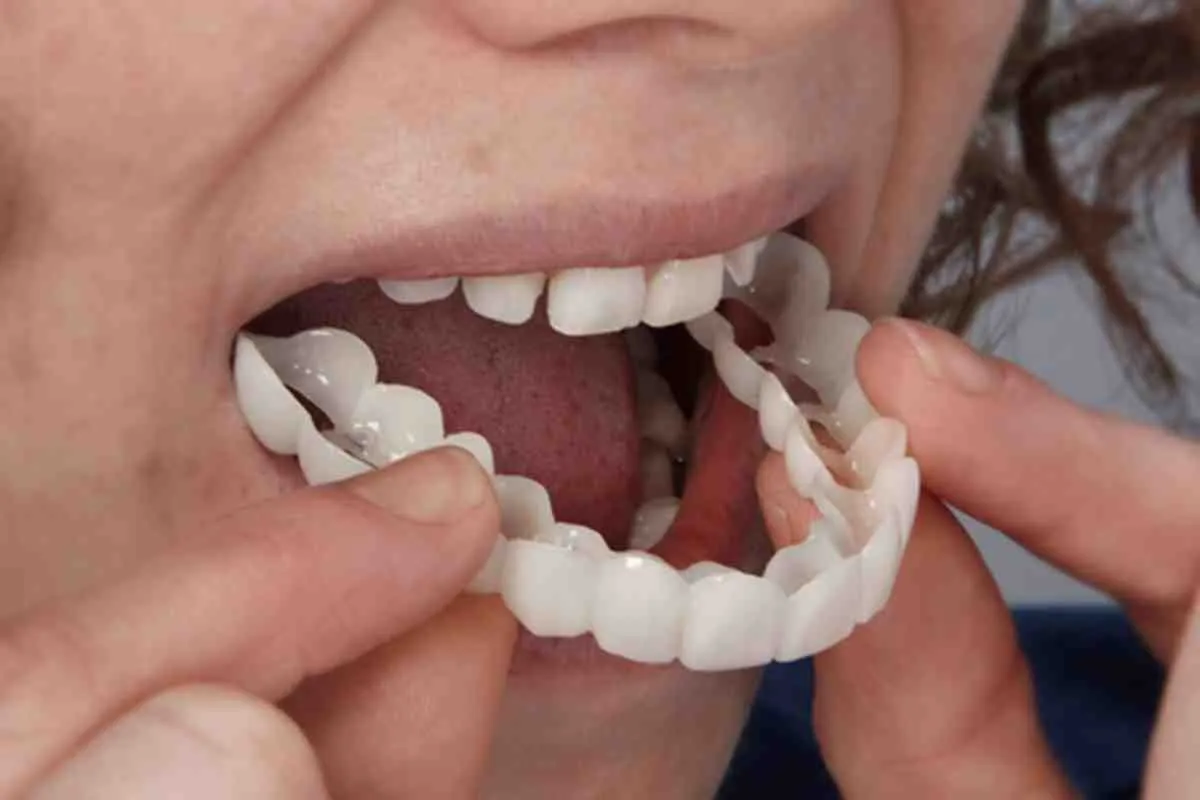 Veneer Definition: Understanding Dental Veneers Guide