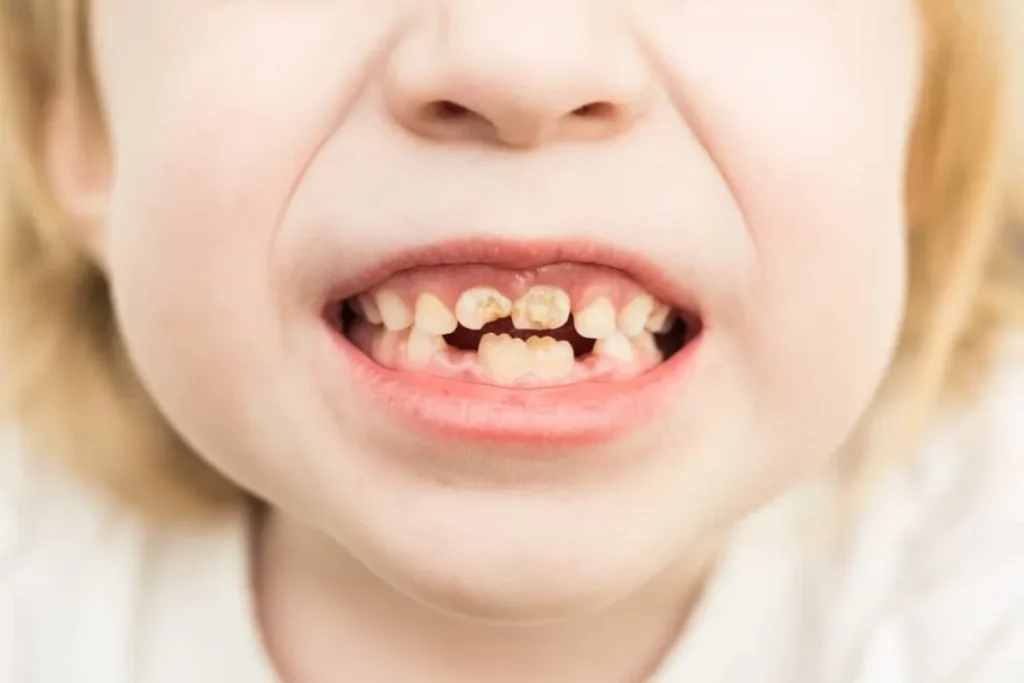 Loose Tooth For Children: Best Amazing Tip