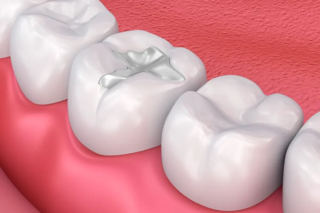 5 Key Facts About Metal Fillings