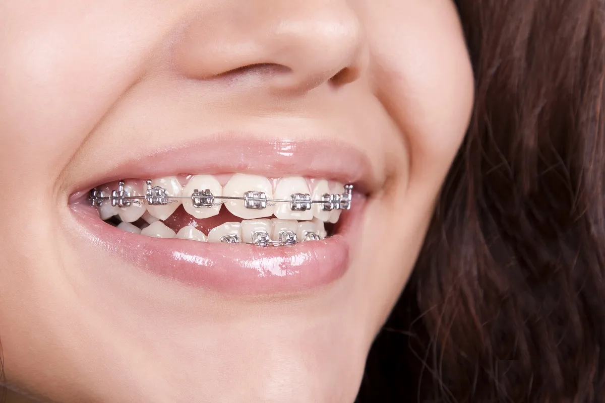 Orthodontist Braces Kit: Best Amazing Use