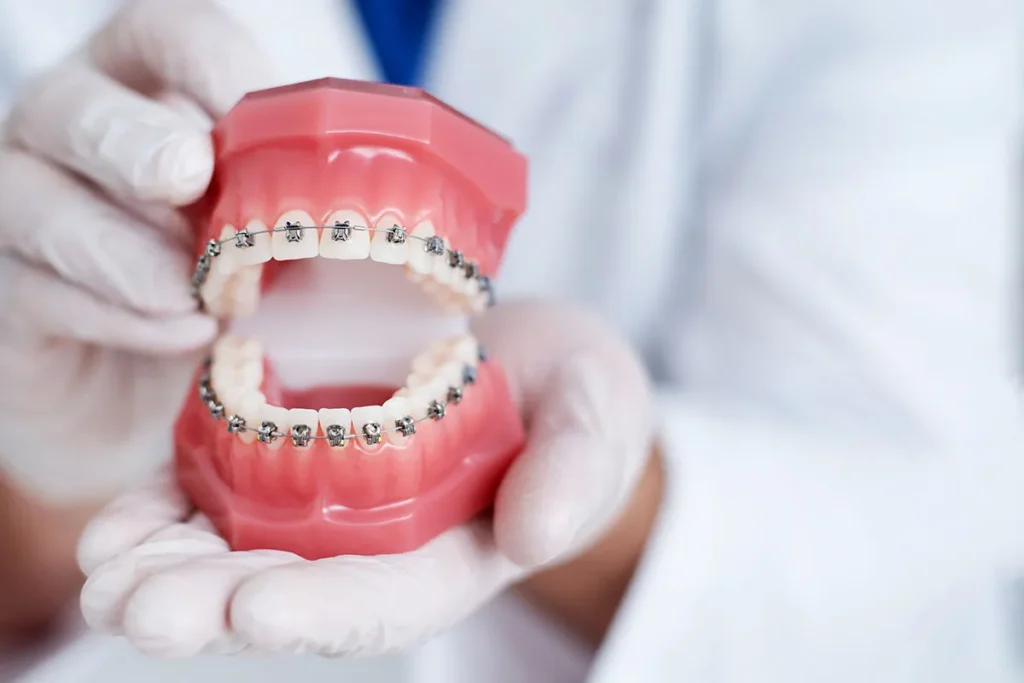 Why Dental Professionals Warn Against At-Home Orthodontist Braces Kits