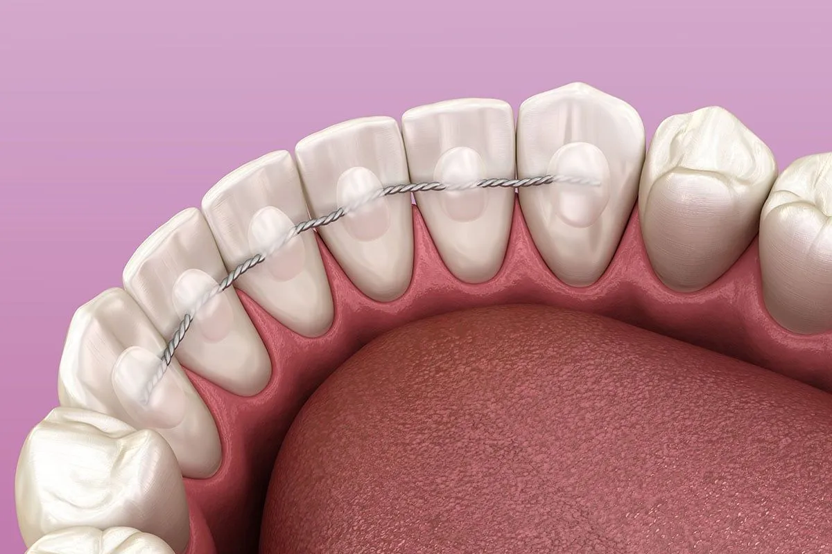 Clear Orthodontic Retainer: Best Amazing