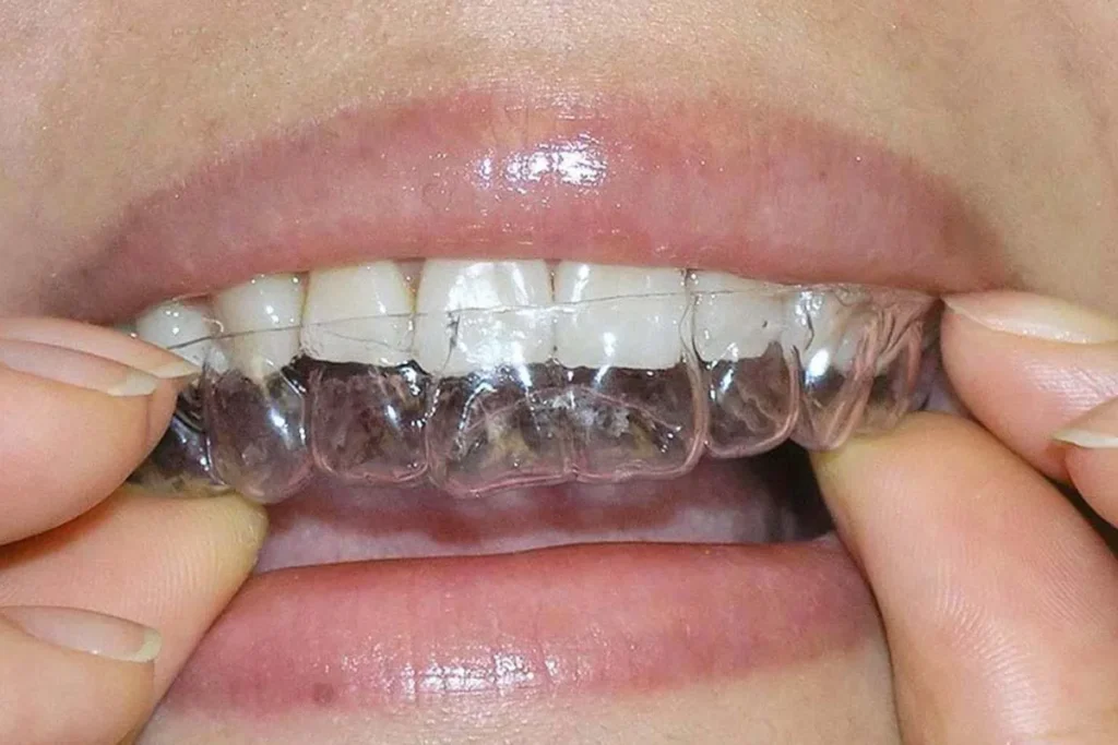 Understanding Clear Orthodontic Retainers