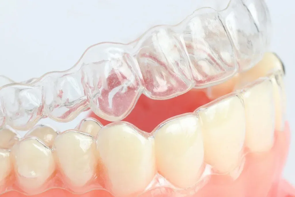 Understanding Retainers: Your Post-Braces Essential