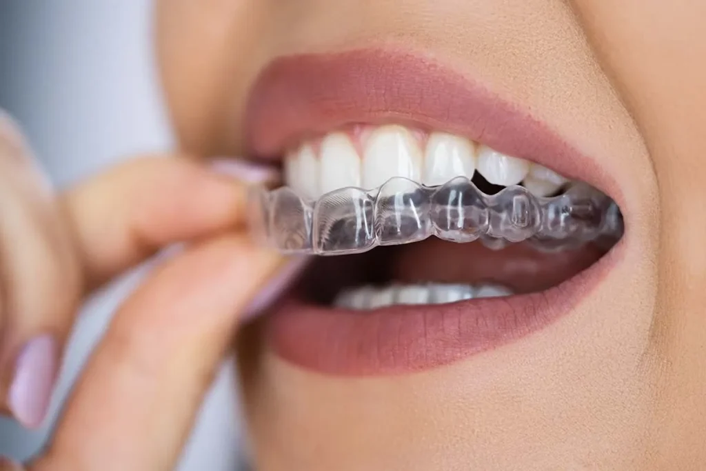 Removable Dental Braces: Amazing Best Fix