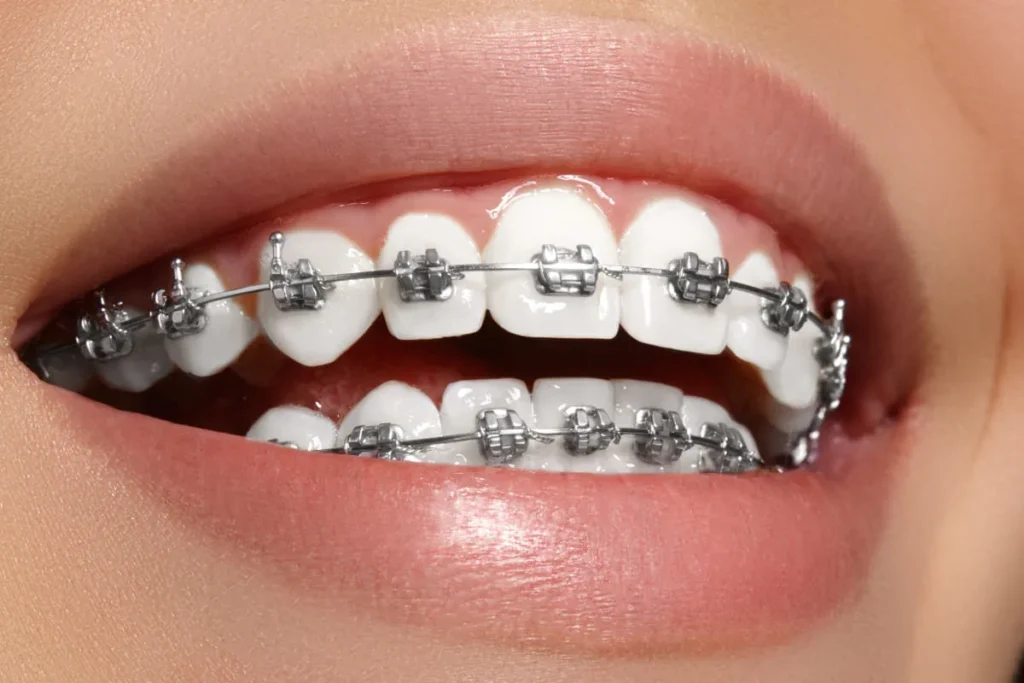 Understanding Removable Dental Braces for Adults