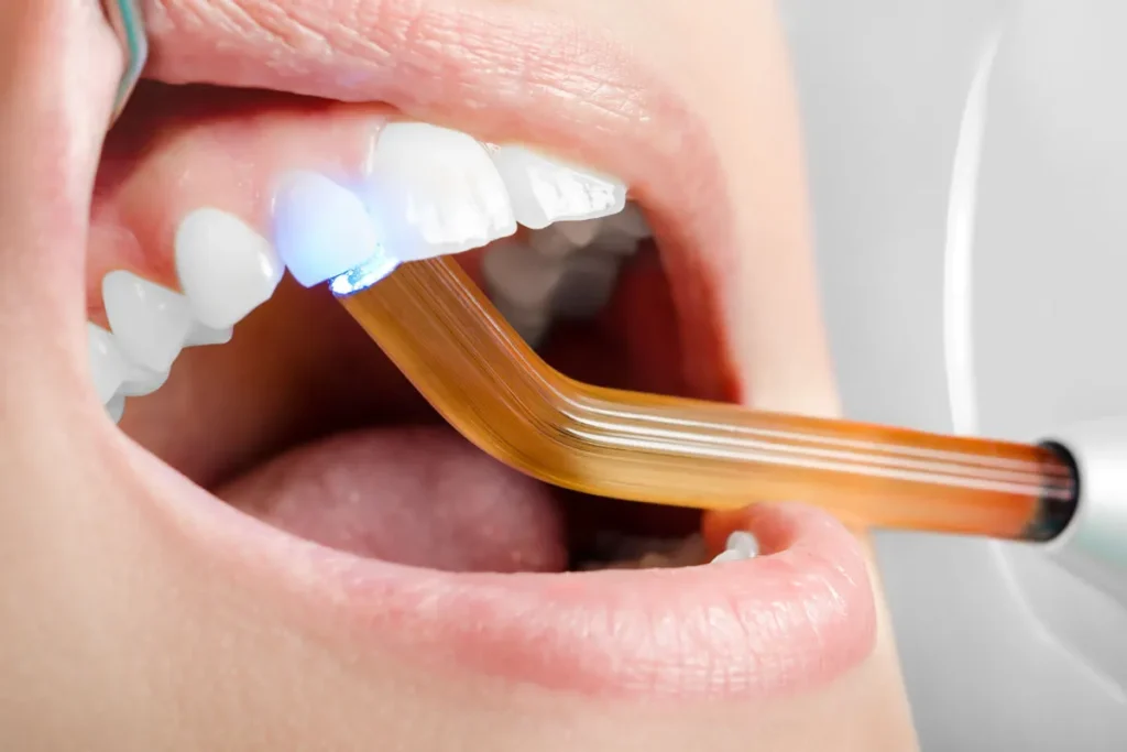 Resin On Teeth: Best Amazing Smile Repair