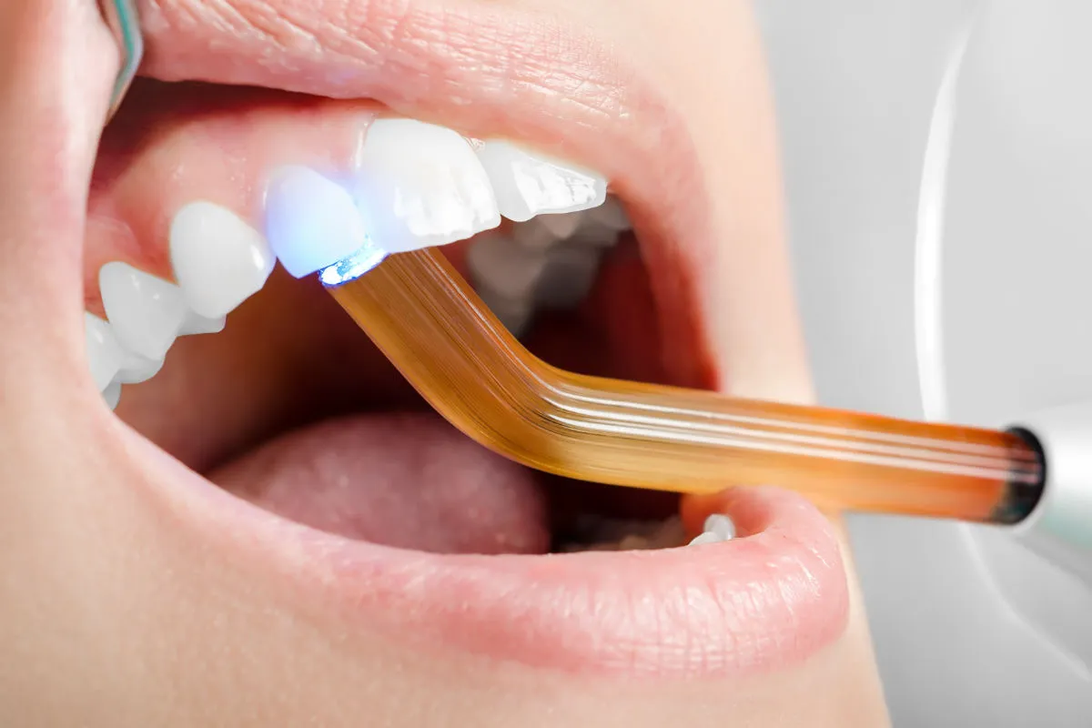 Resin On Teeth: Best Amazing Smile Repair