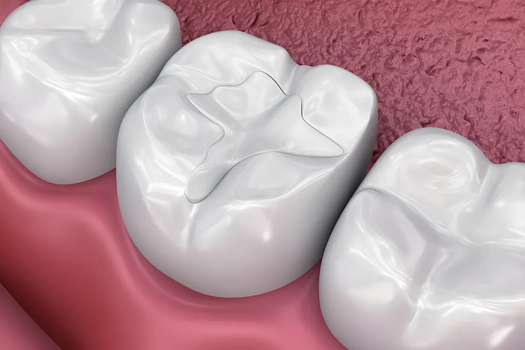 Understanding Resin Dental Fillings and Their Composition