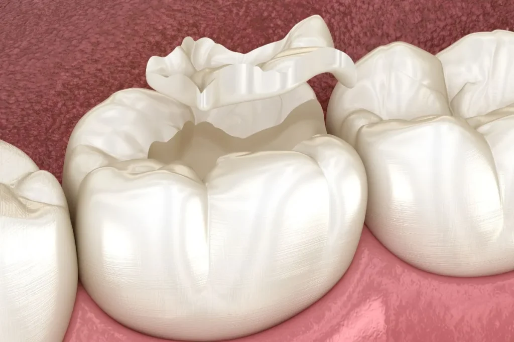 Benefits of Choosing Resin Dental Fillings Over Amalgam