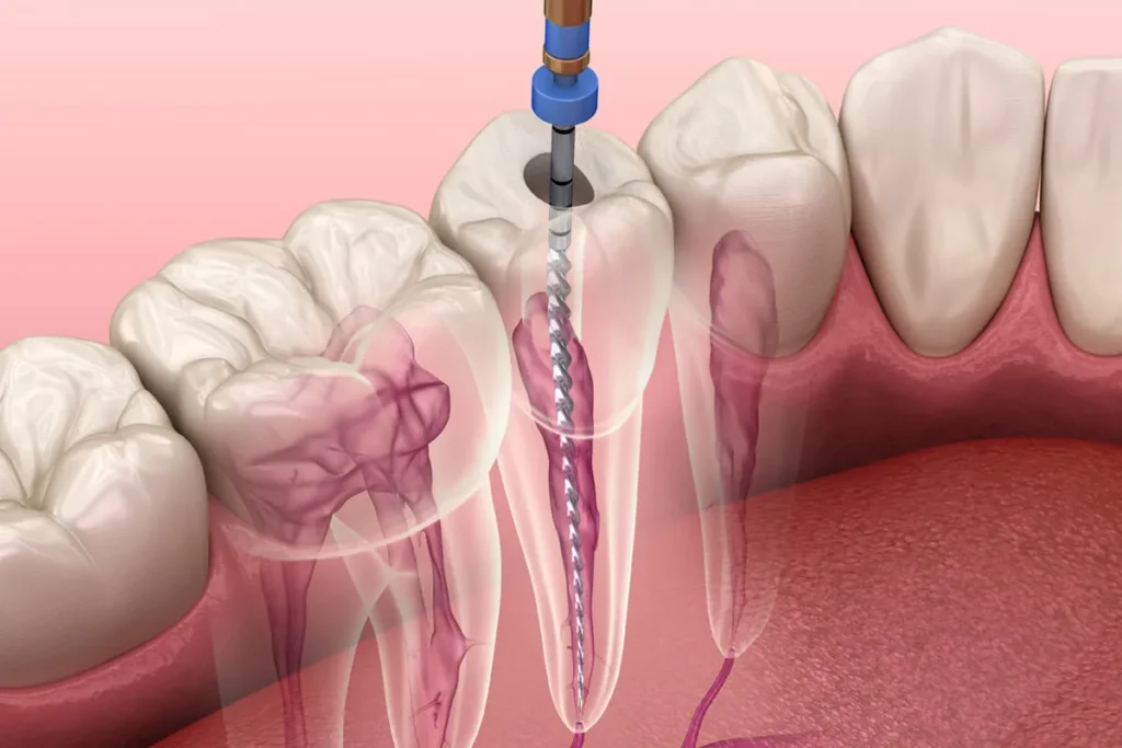 Understanding Root Canal Anesthesia Options