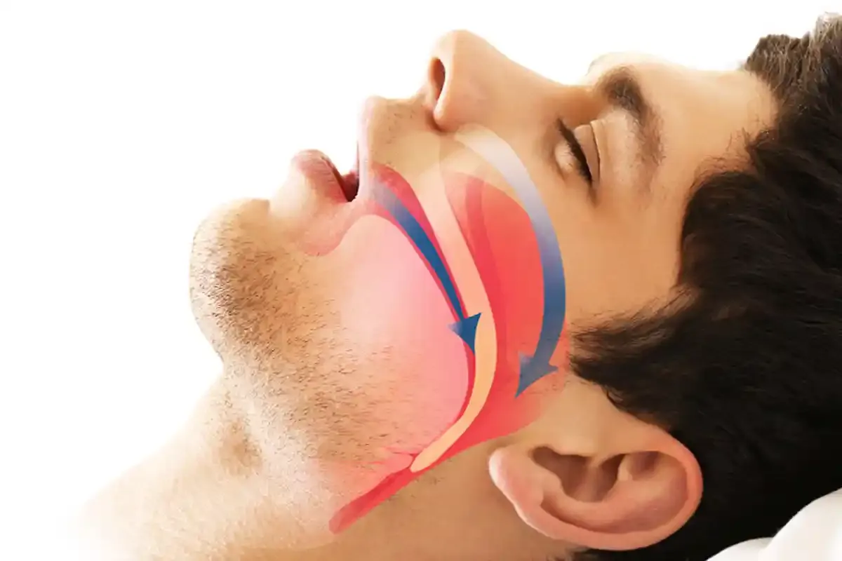 Sleep Apnea Dental: Best Amazing Solutions