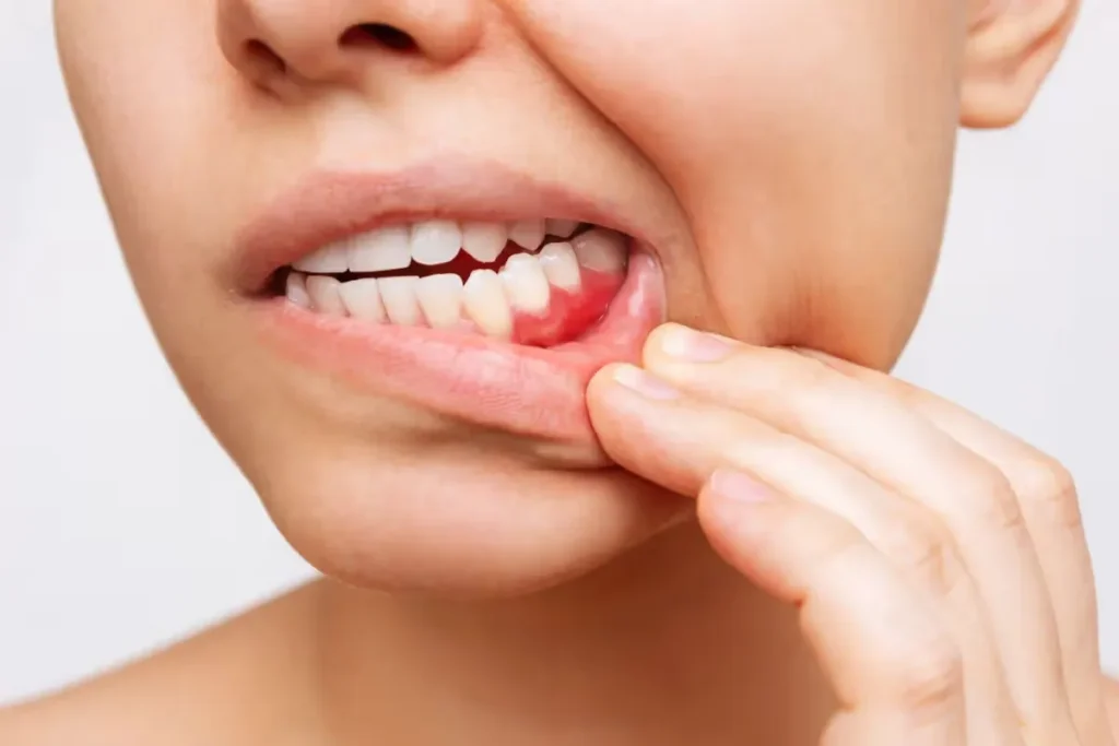 Normal Timeline for Gum Swelling After Extraction