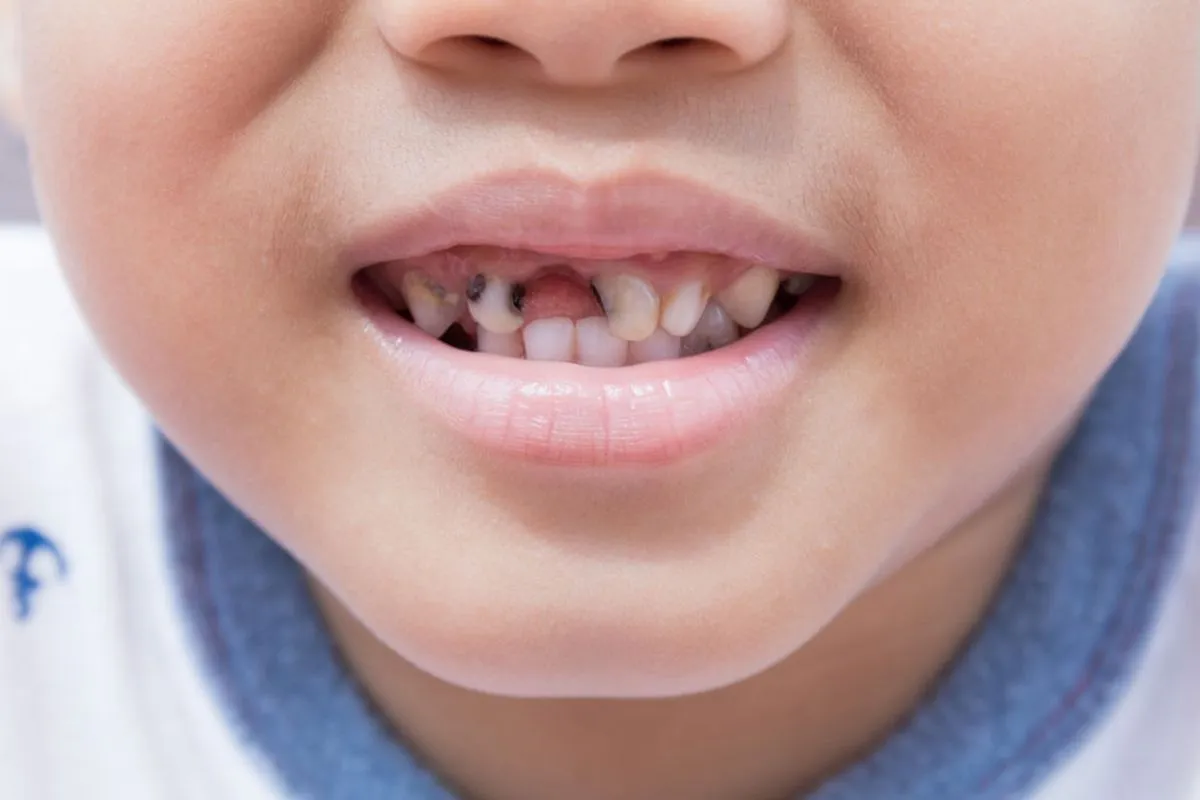 Tooth Hole Filler: Best Amazing Temporary