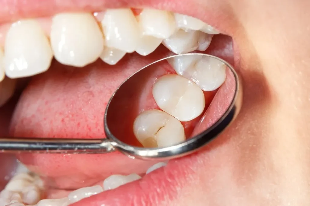 Types of Temporary Dental Filling Materials