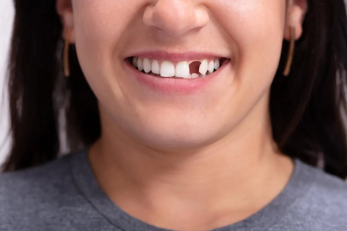 Missing A Tooth Options: Amazing Best Fix