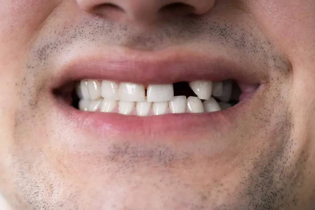 The Impact of Missing Teeth on Oral Health