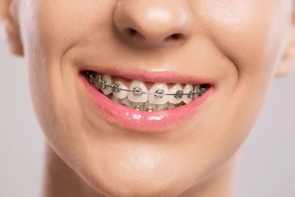Understanding Ceramic Braces and How They Work