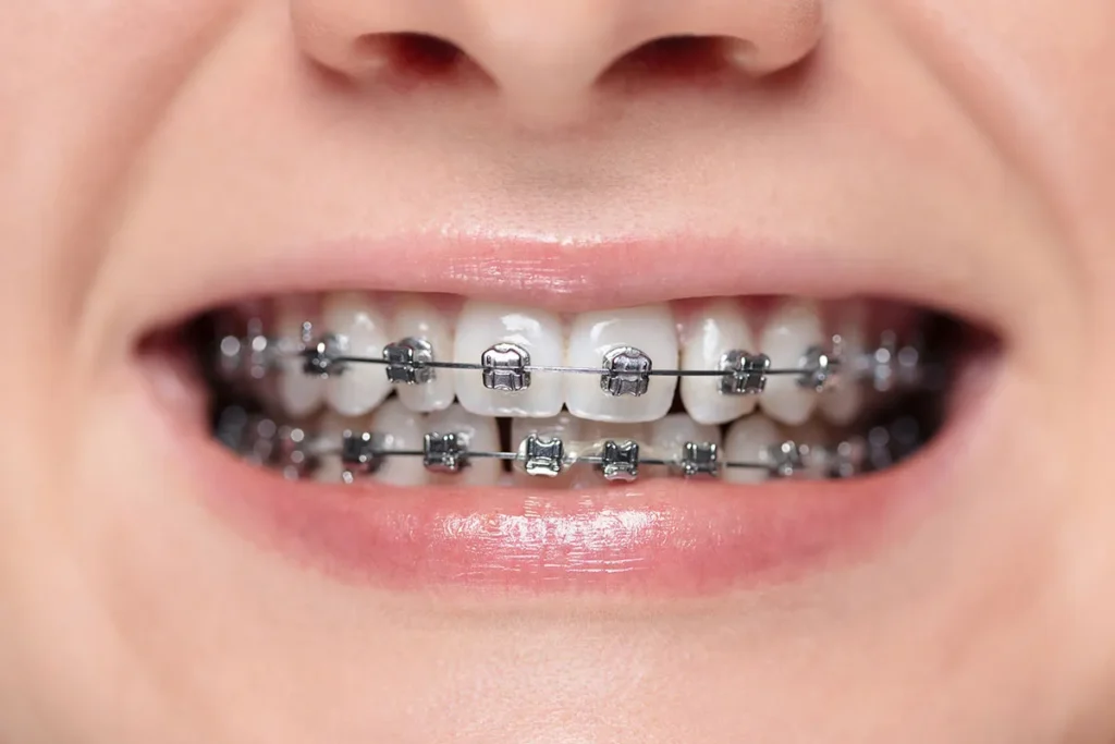 4 Key Advantages of Ceramic Braces