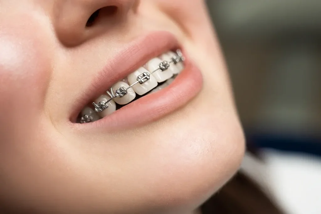 Understanding Clear and Metal Braces
