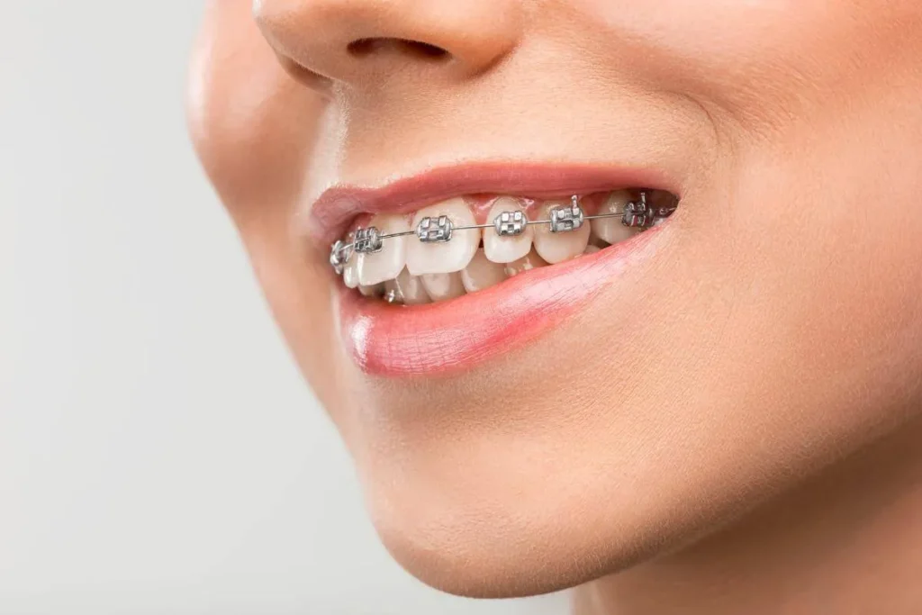 How Porcelain Braces Compare to Traditional Metal Options