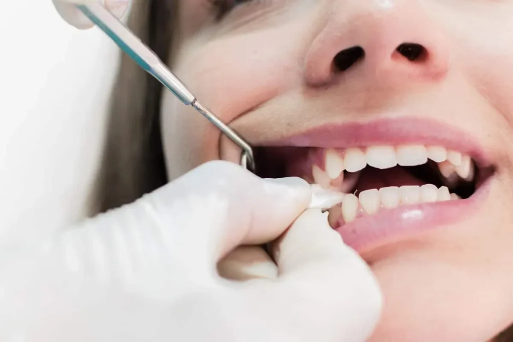 White Spot After Tooth Extraction: Normal or Concerning?