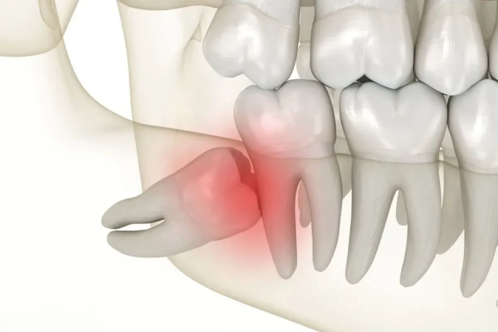 Pericoronitis Treatment Options