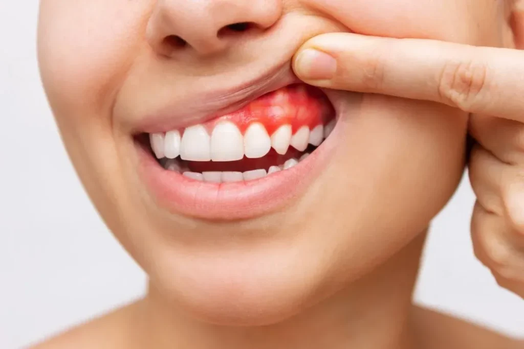Understanding Gum Inflammation: A Common Health Concern