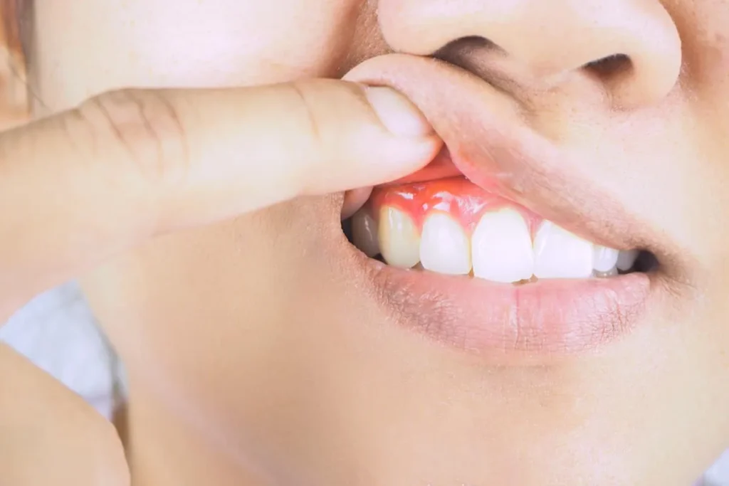What Causes Gum Inflammation and Swelling
